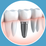 Implantes Dentales